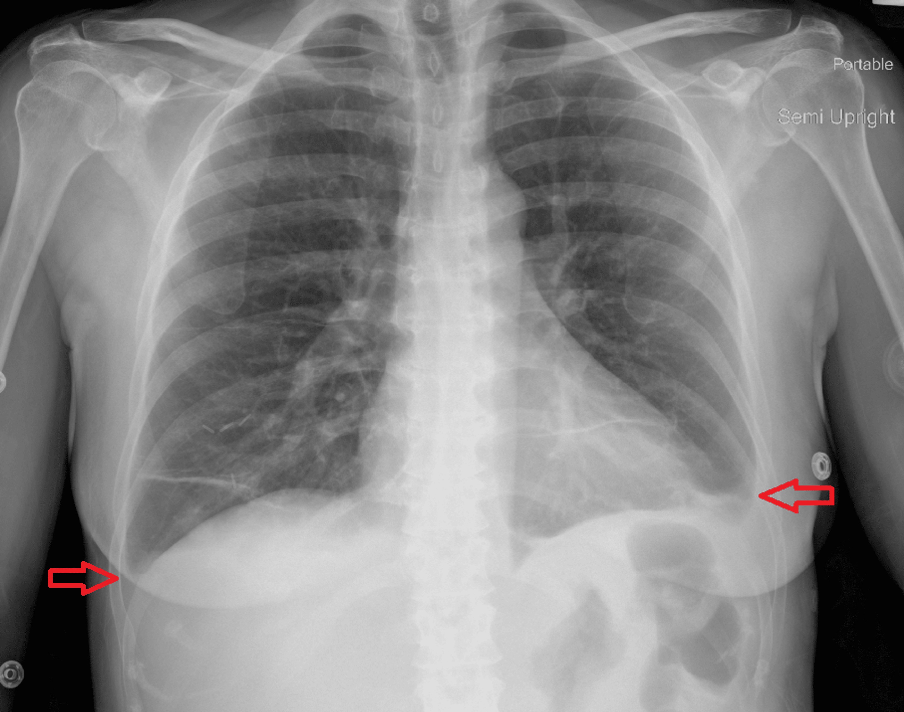 Follow-up chest X-ray showing improvement in pleural effusions