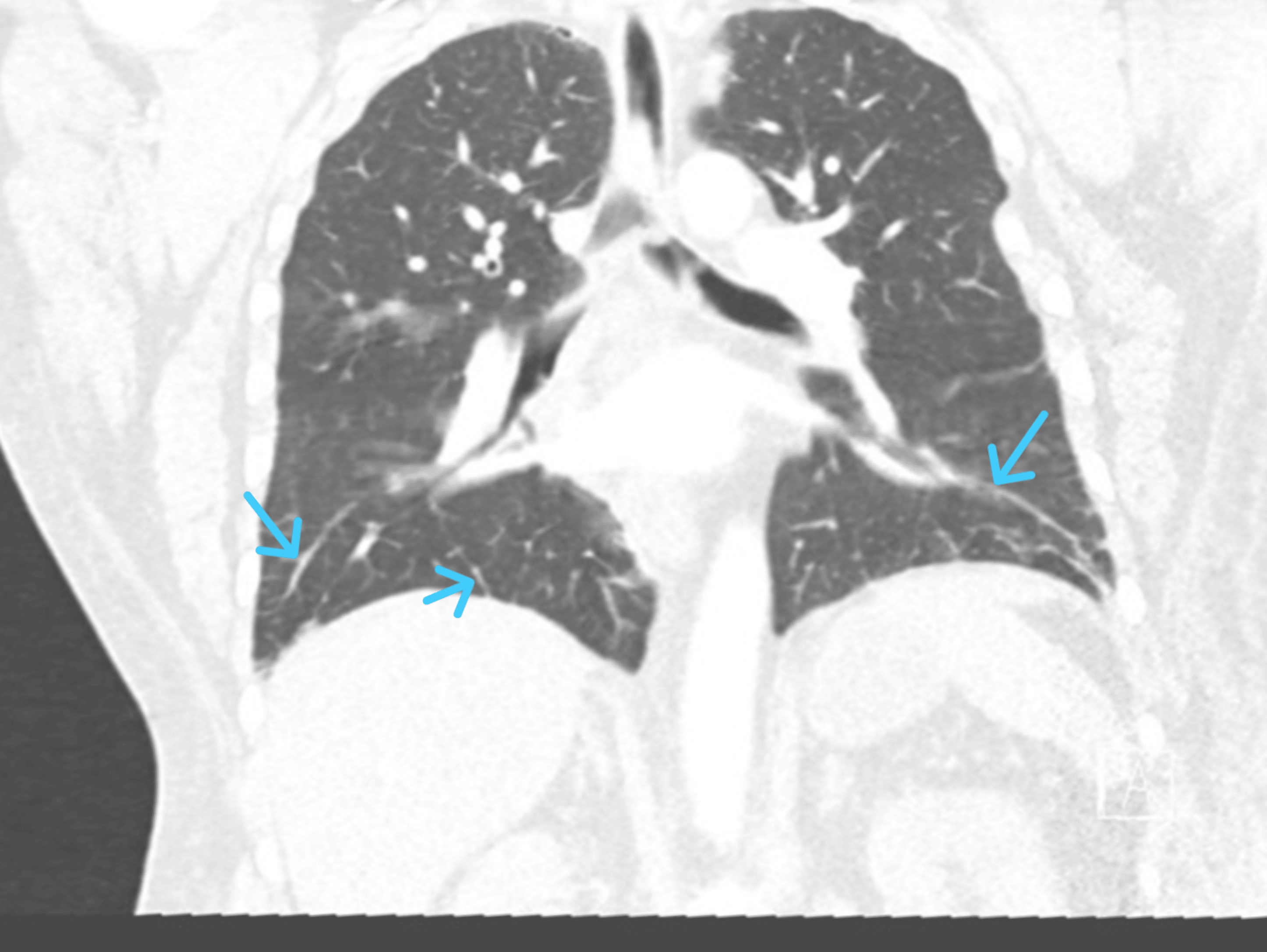CT pulmonary angiogram showing bi-basal pulmonary oedema