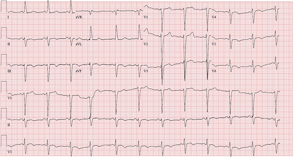 ECG showing normal sinus rhythm, left axis deviation, and LBBB
