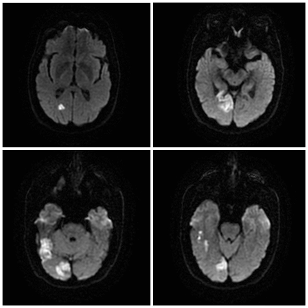 DWI MRI showing right occipital and posterior temporal infarction