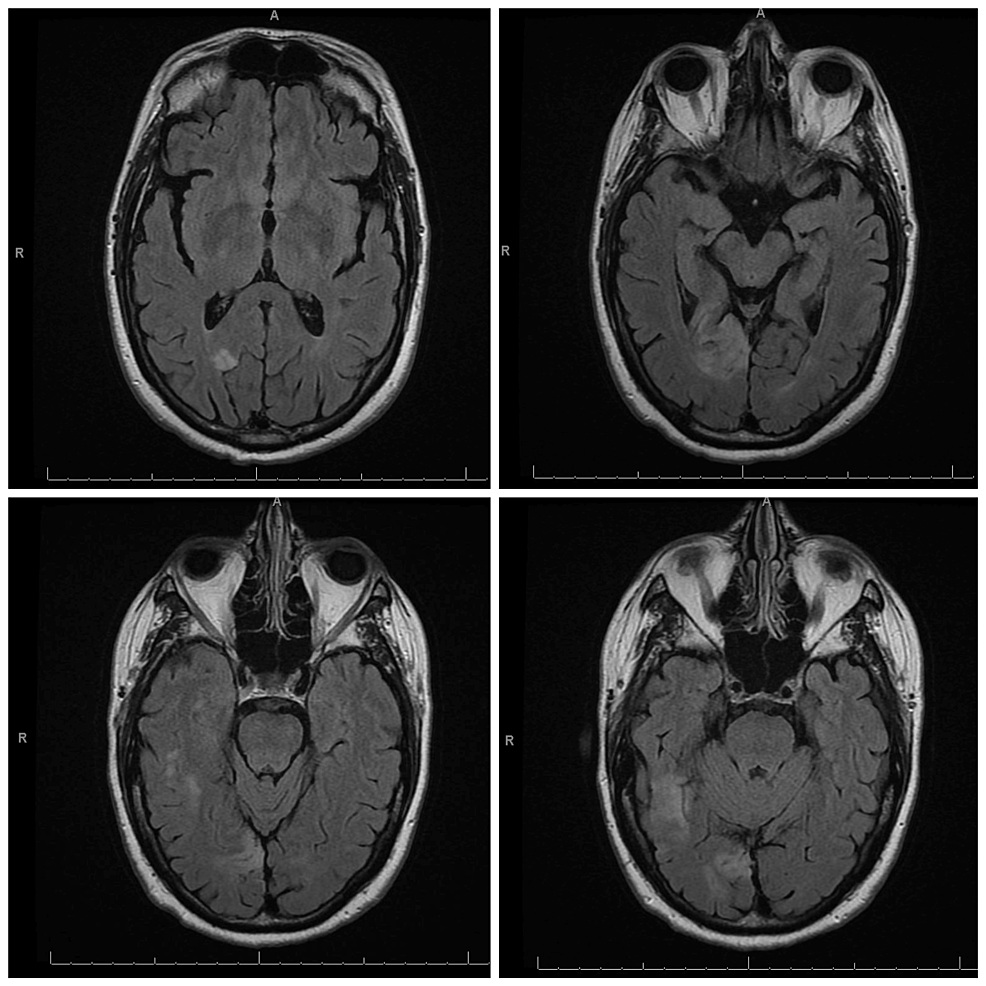 T2 MRI showing vasogenic edema in right occipital lobe