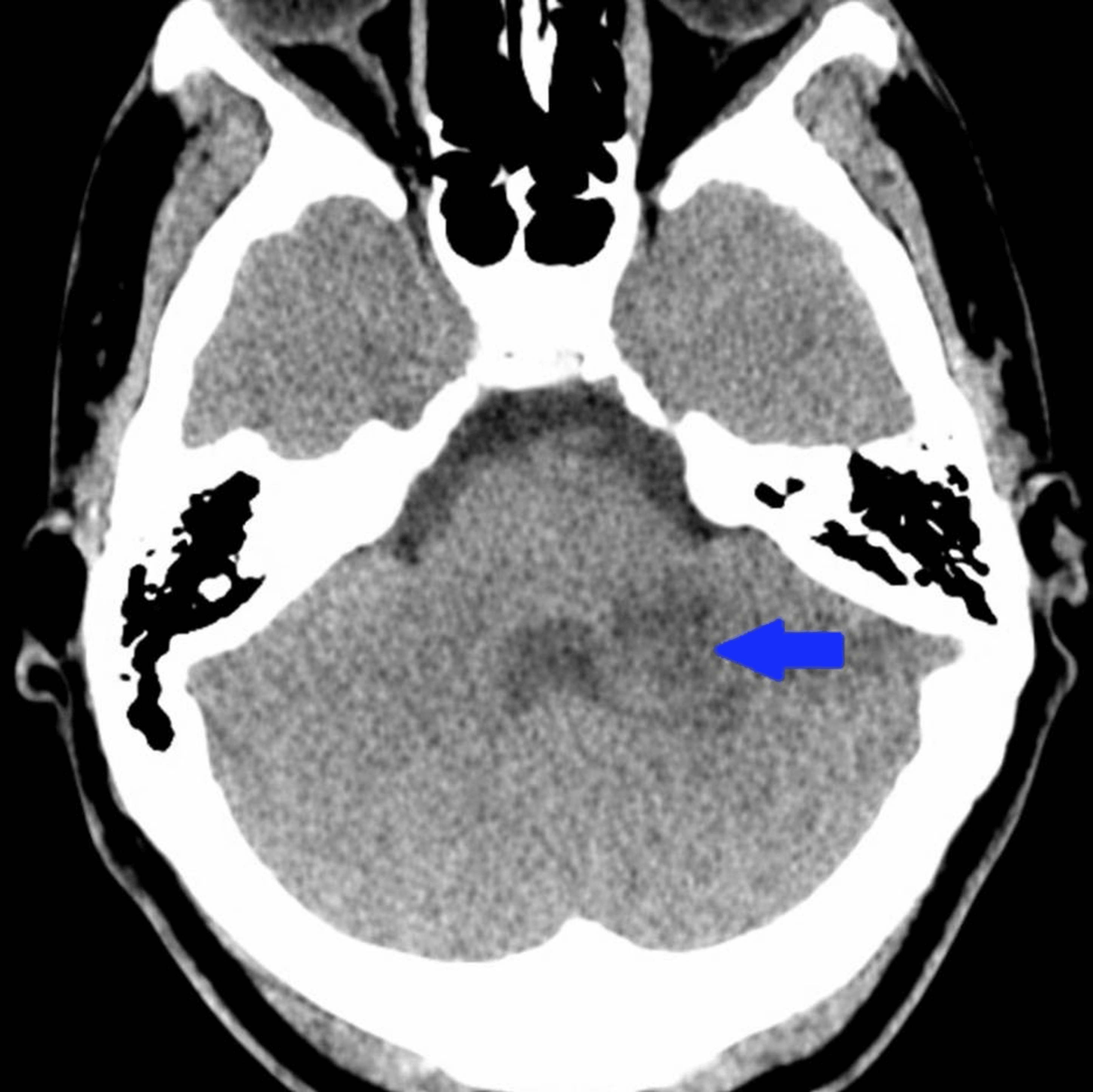 CT brain showing left cerebellar hypodense lesion