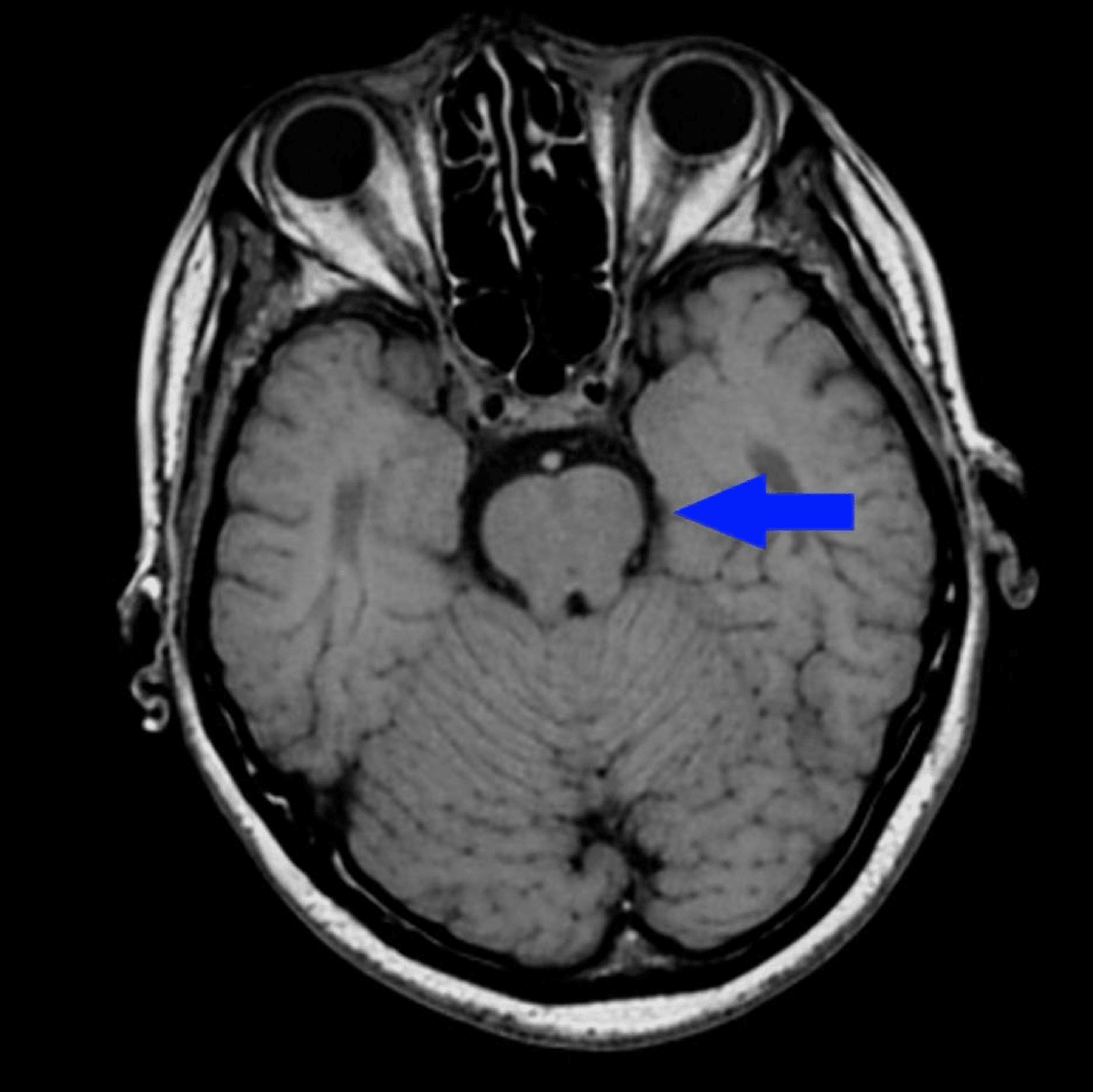 MRI brain 4 days post-ROSC showing no acute lesion in left cerebellum