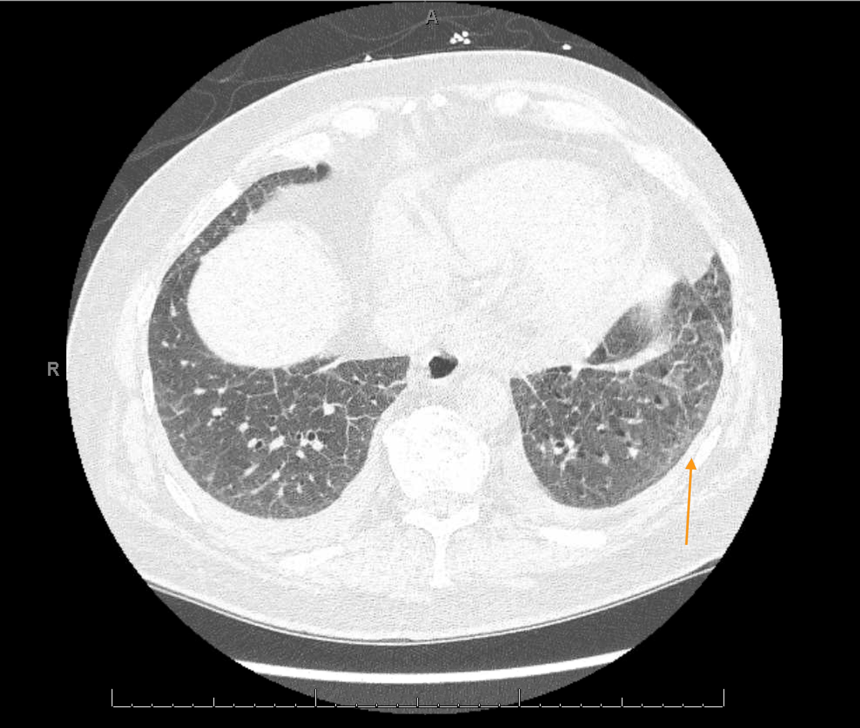 HRCT chest showing ground glass opacities in left middle lobe