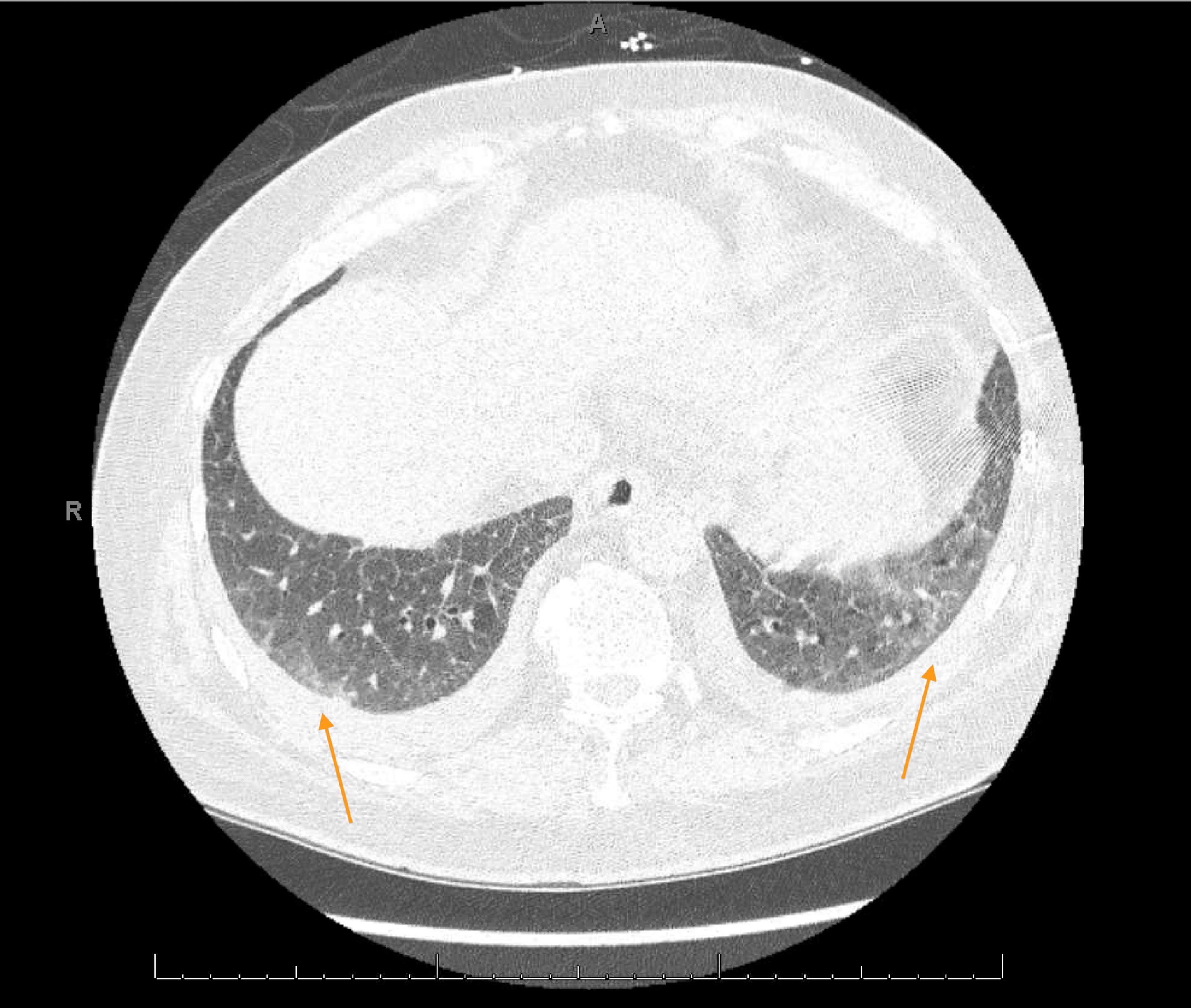 HRCT chest showing bilateral ground glass opacities, middle lobes