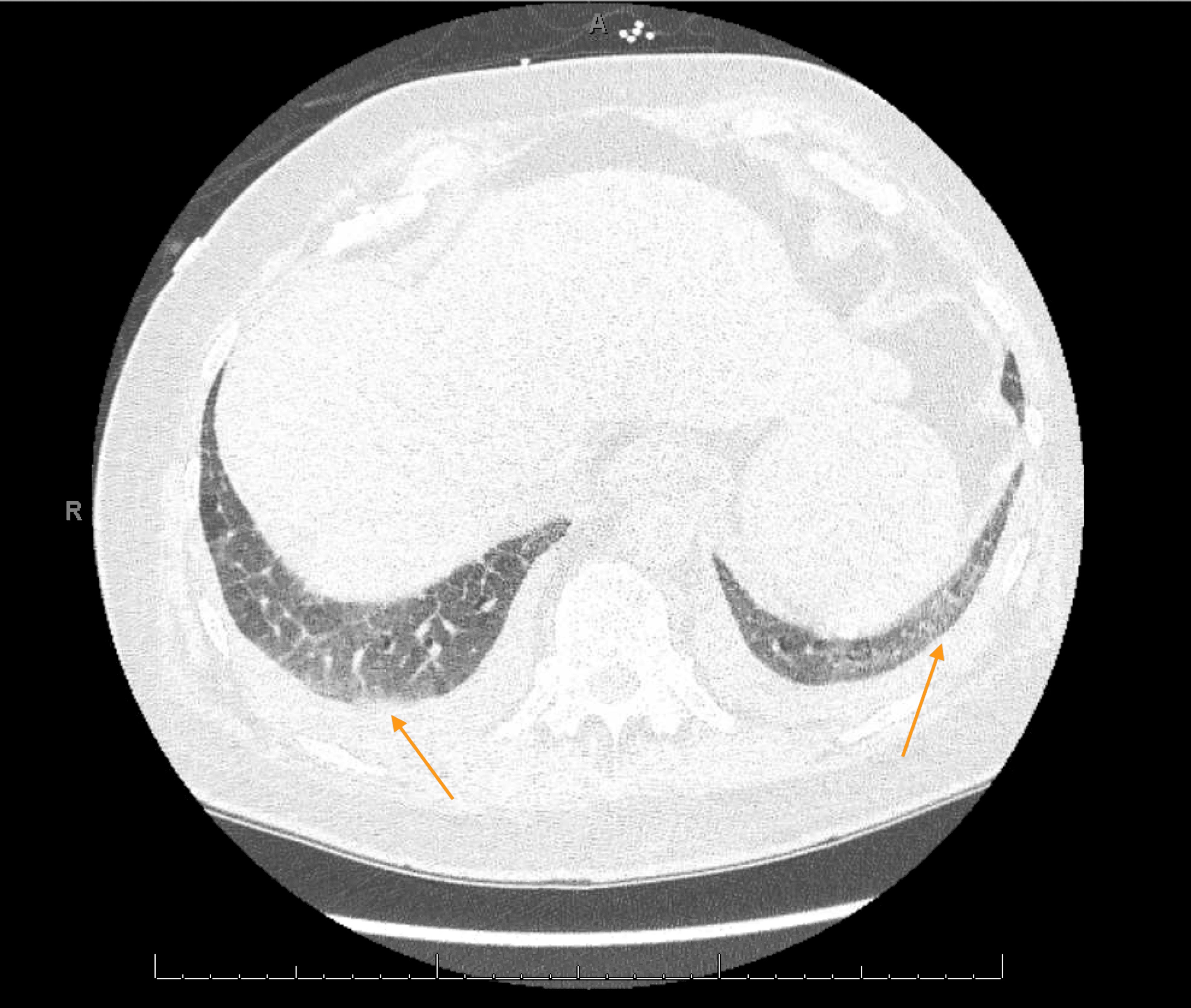HRCT chest showing bilateral ground glass opacities, lower lobes