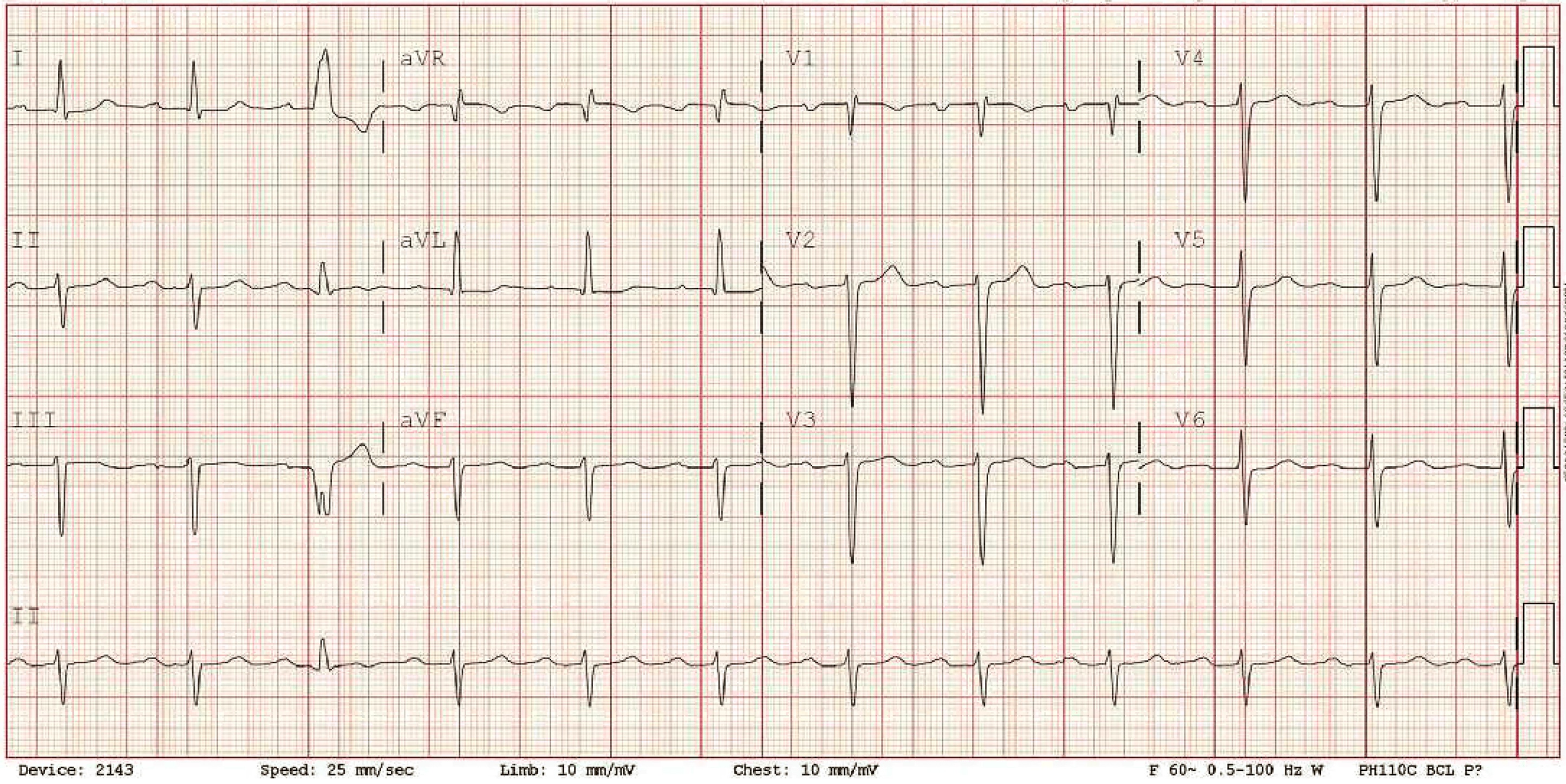 ECG showing prolonged PR, incomplete RBBB, and incomplete LAFB