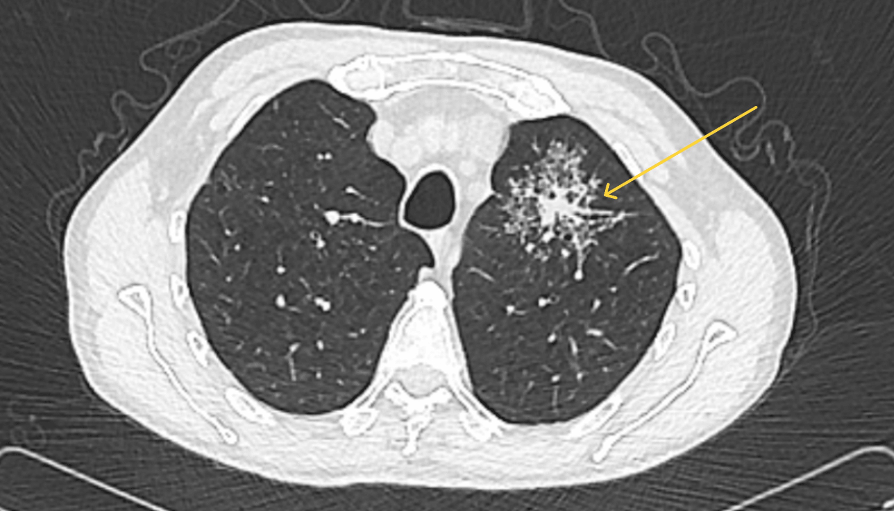 Low-dose CT scan showing a left upper lobe dense central nodule surrounded by satellite lesions in the characteristic galaxy sign pattern