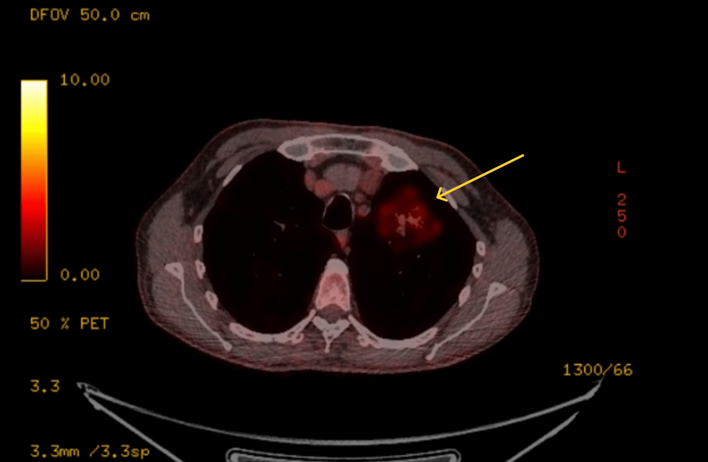 FDG PET-CT showing mild heterogeneous uptake SUVmax 3.1 within the left upper lobe lesion