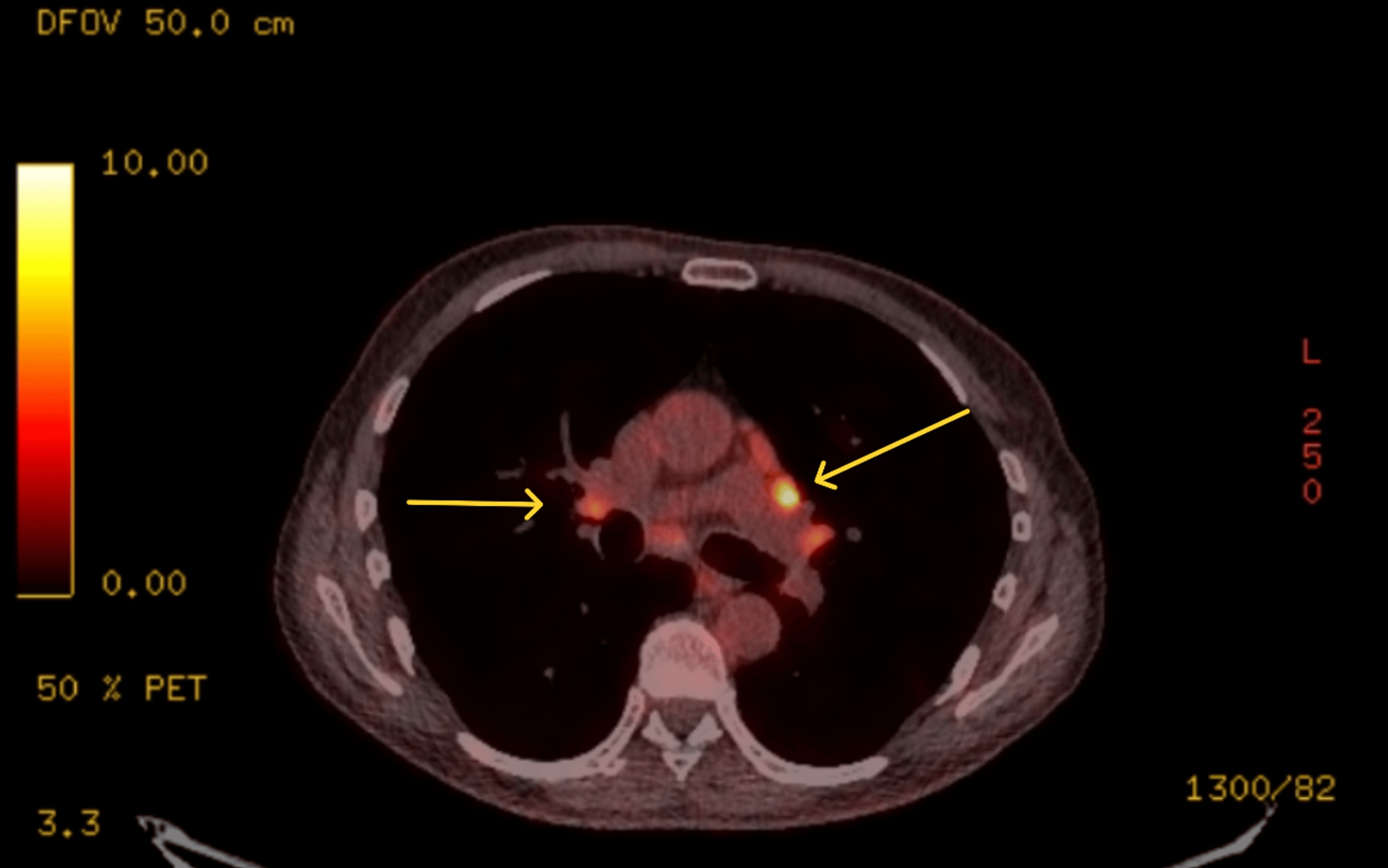 FDG PET-CT showing enlarged bilateral hilar lymphadenopathy with markedly increased FDG uptake SUVmax 12.5