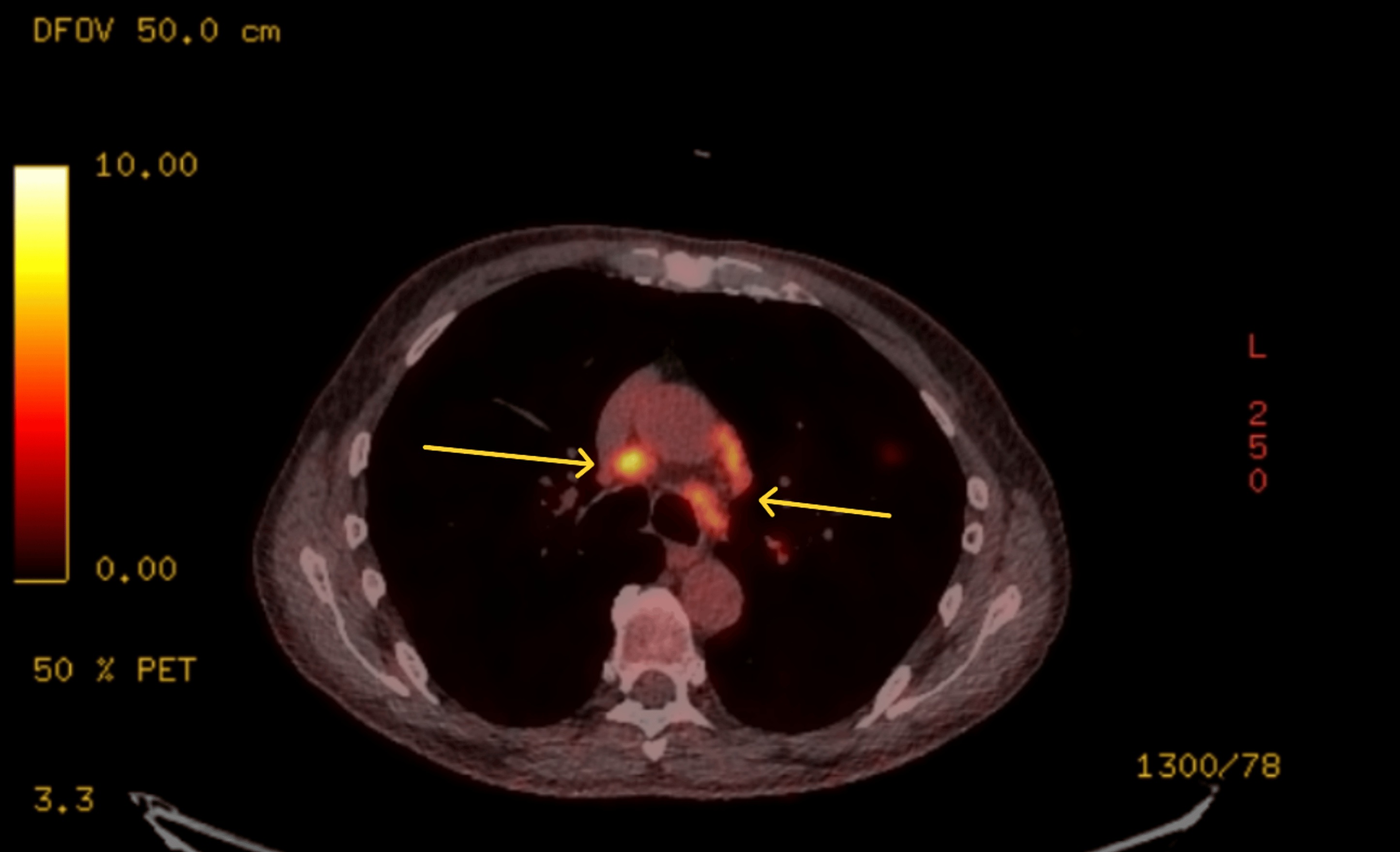 FDG PET-CT showing enlarged mediastinal lymphadenopathy with markedly increased FDG uptake
