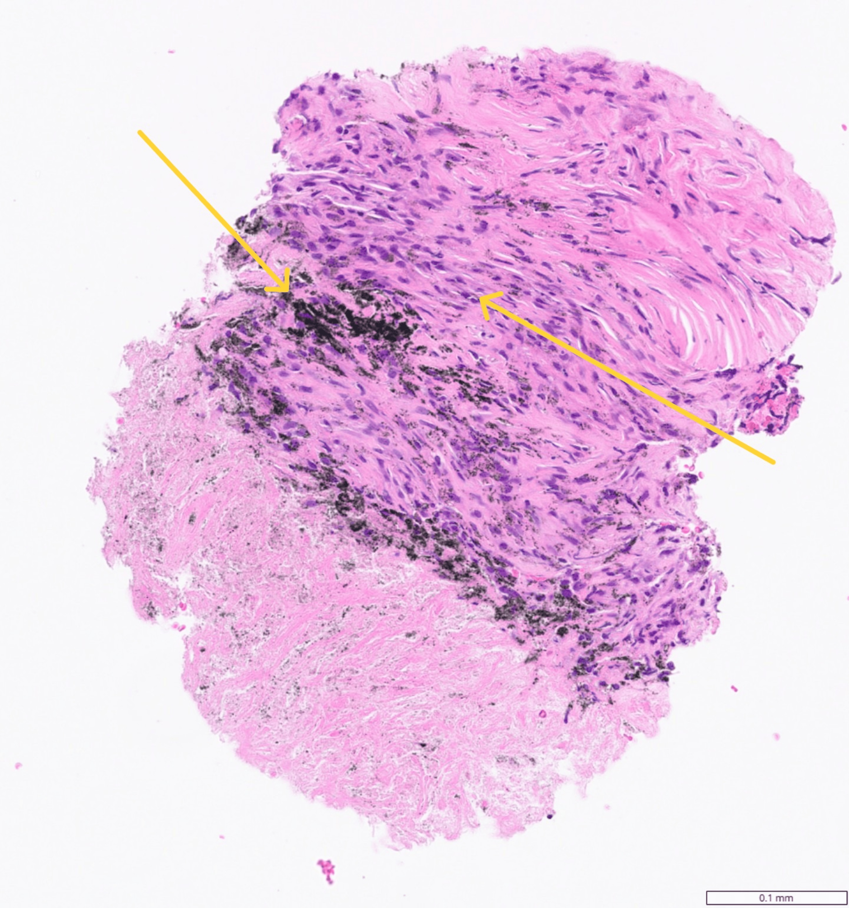 Photomicrograph of a lymph node showing fibrosis and anthracosis consistent with burnt-out granulomatous inflammation