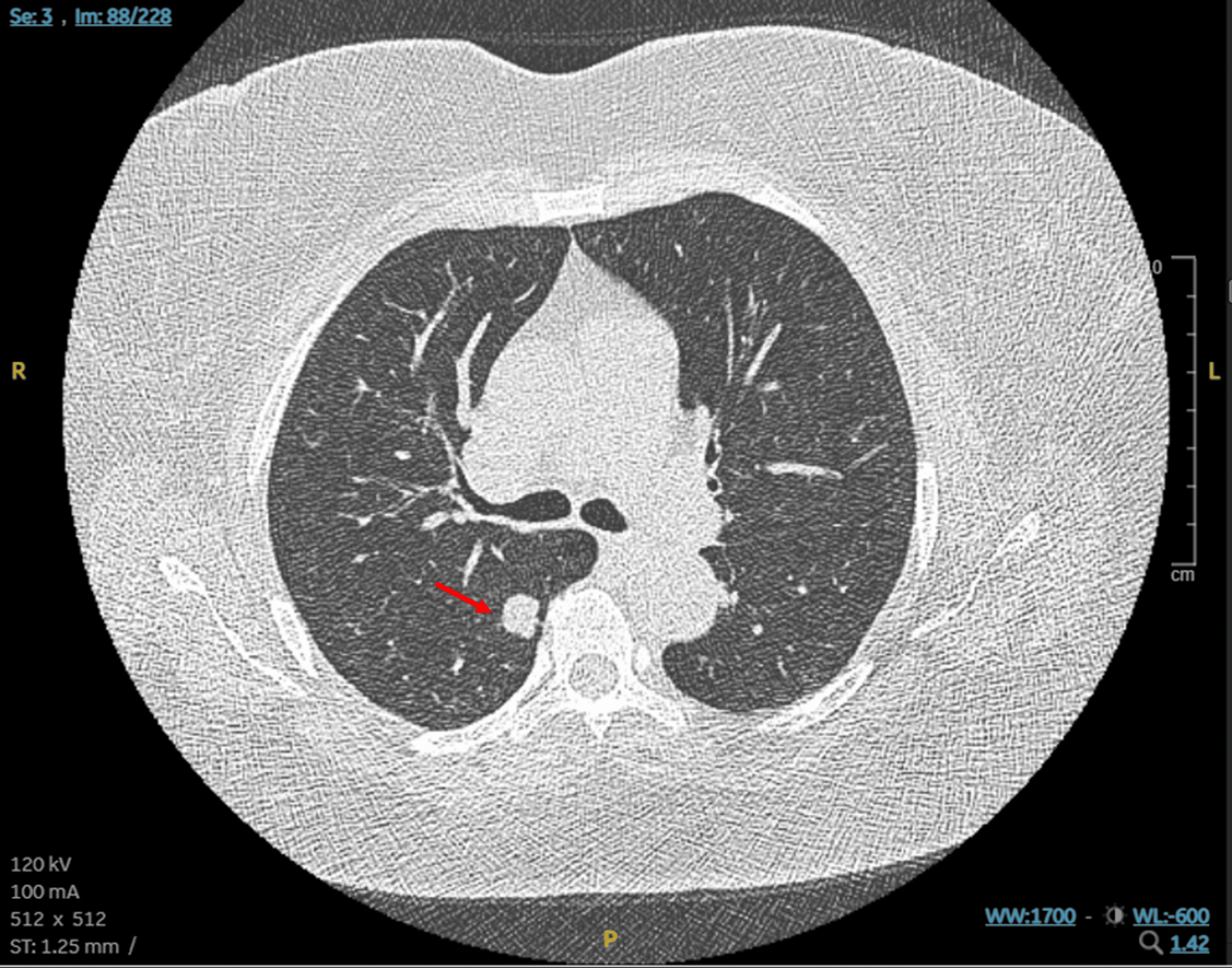 LDCT chest showing a 1.6 cm solitary pulmonary nodule in the right lower lobe superior segment with no hilar or mediastinal lymphadenopathy
