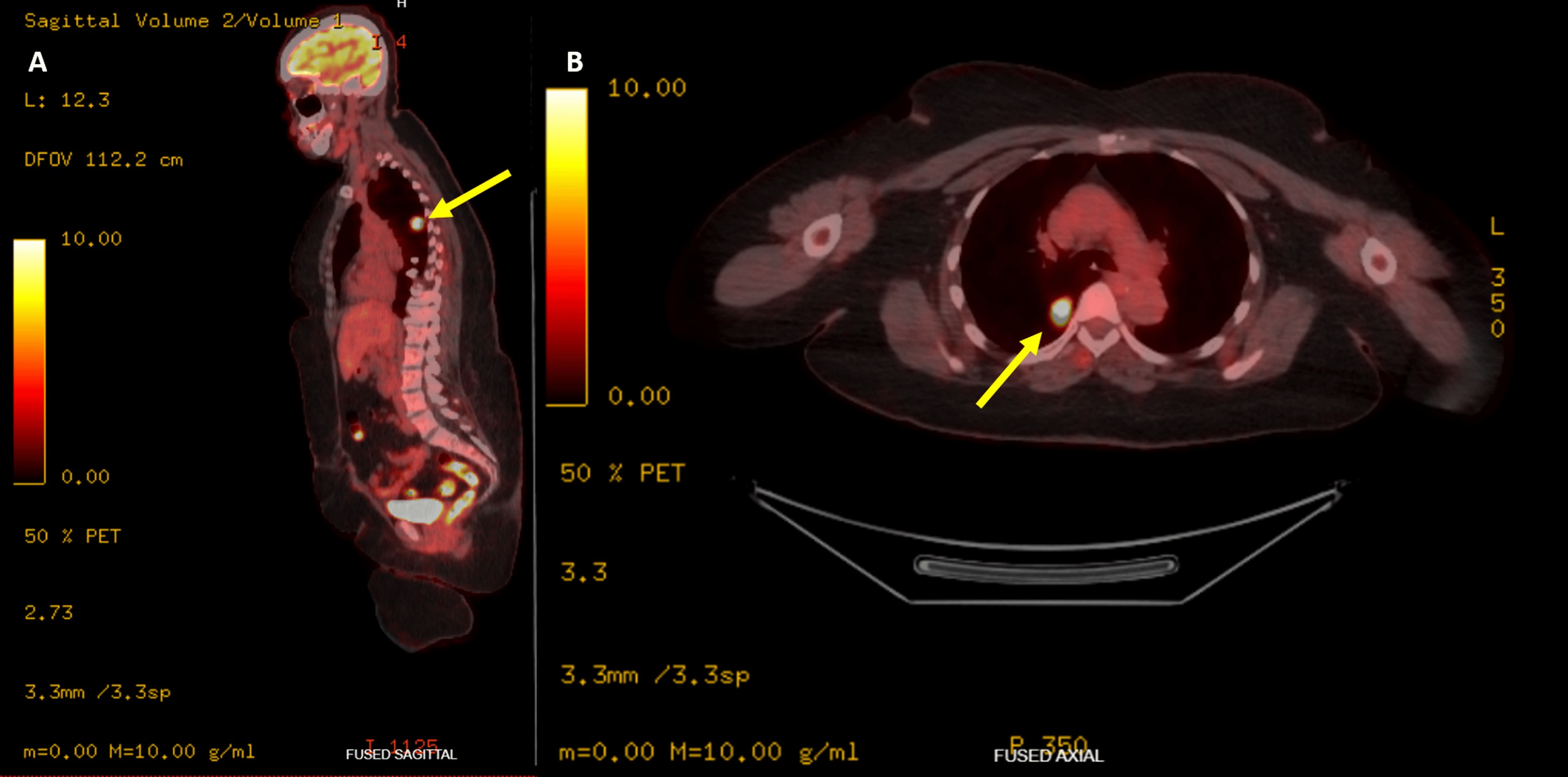 PET-CT showing intense FDG uptake localized to the right lower lobe nodule with no nodal or distant metastasis