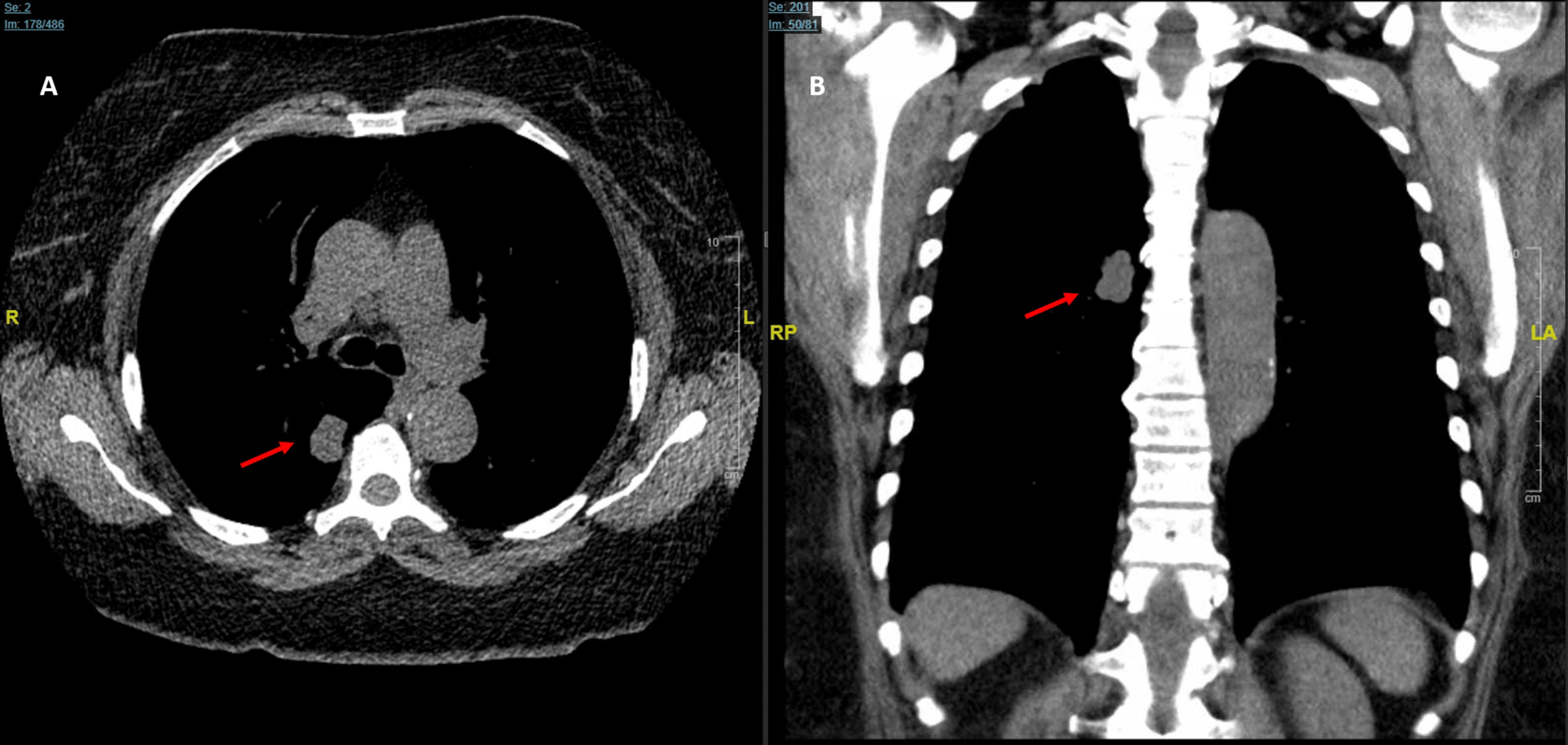 Interval CT showing growth of the right lower lobe mass from 1.6 cm to 2.2 x 1.4 cm over six months