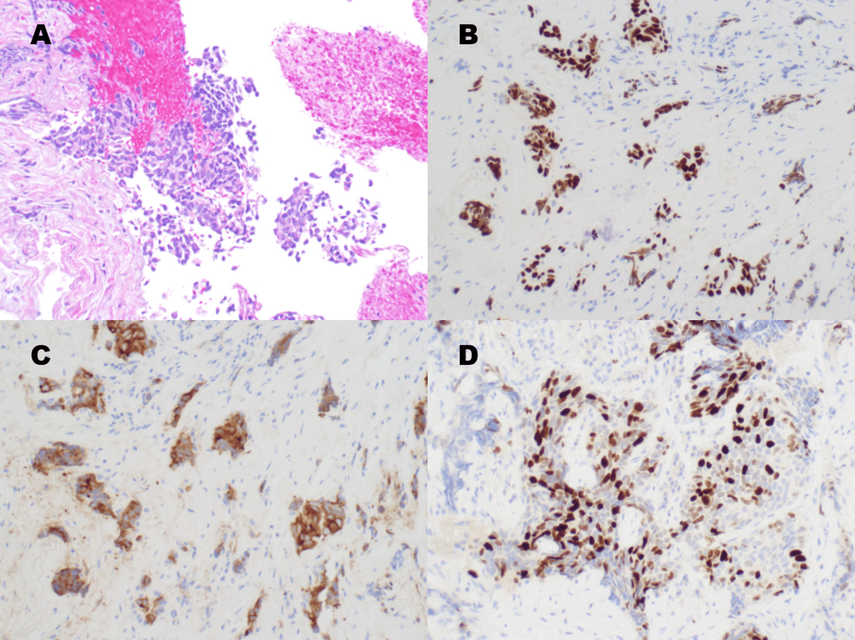 Histopathology and immunohistochemistry showing small round blue cells, TTF-1 positivity, synaptophysin positivity, and Ki-67 greater than 80%