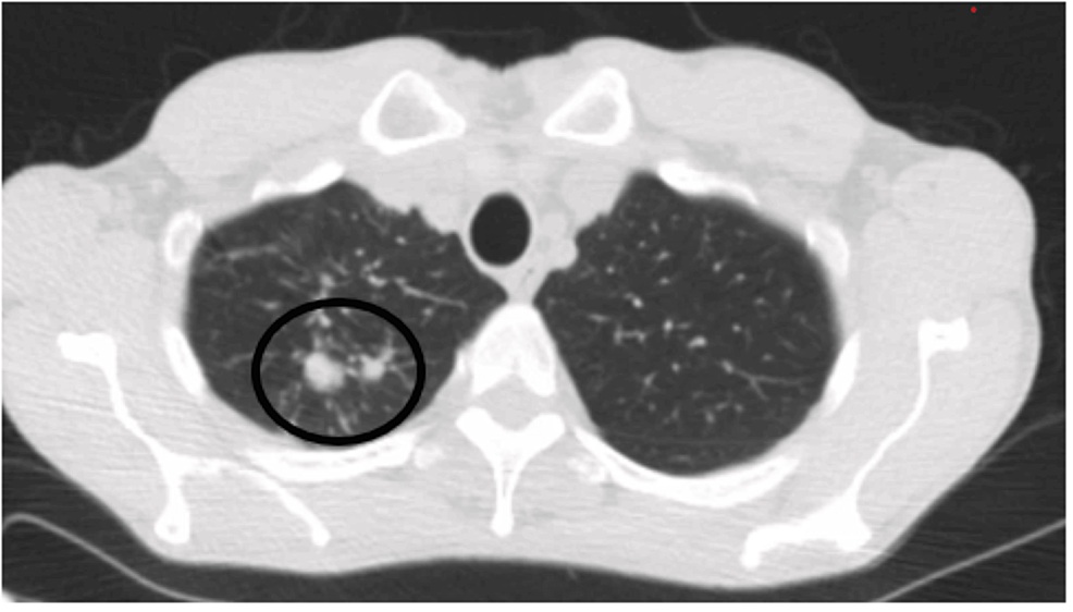 CT scan axial showing two right upper lobe spiculated nodules measuring 24 mm and 17.8 mm with centrilobular emphysema
