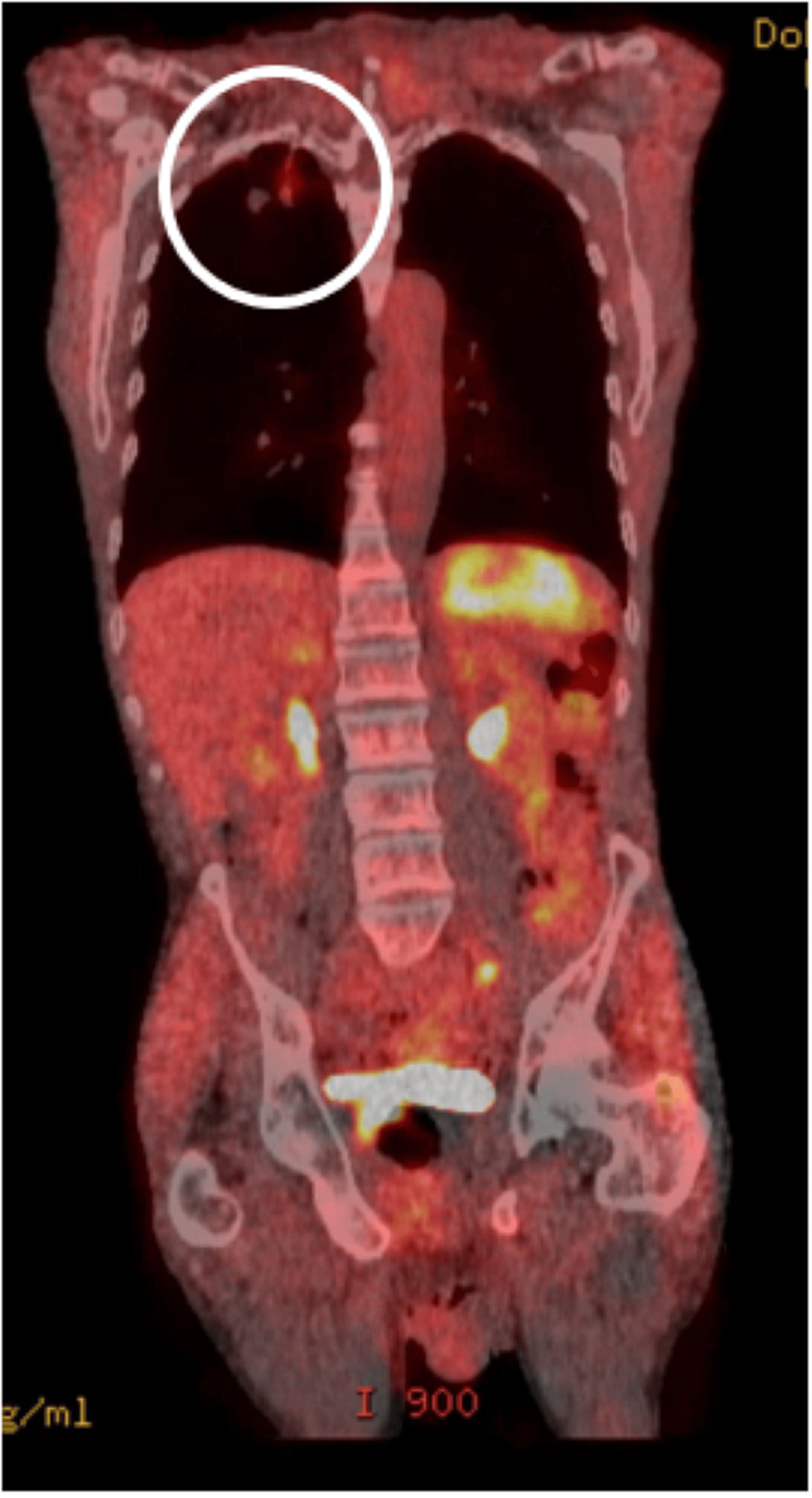 PET scan coronal view showing right upper lobe nodule with SUVmax 4