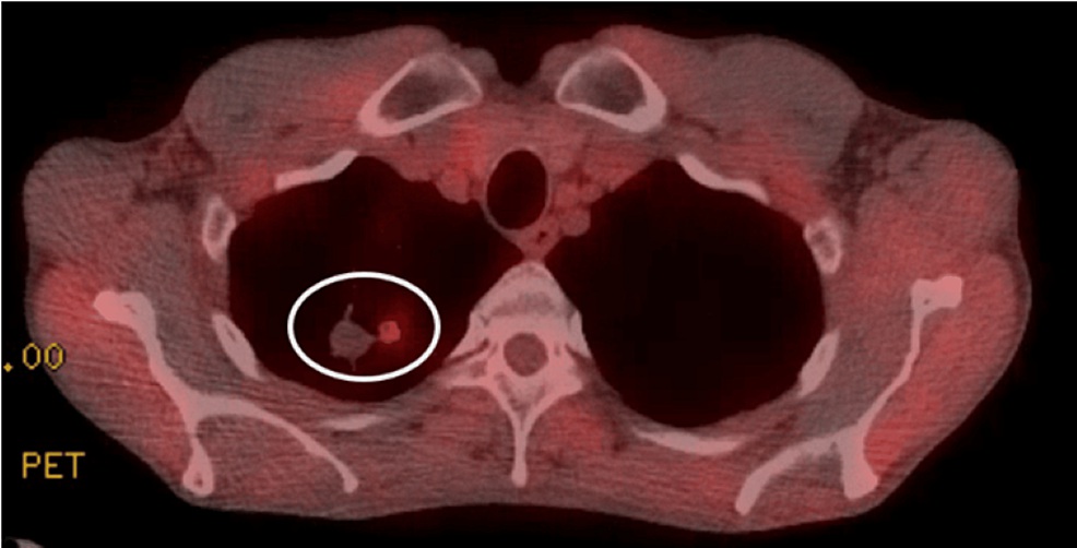 PET scan axial view showing right upper lobe nodule with an SUVmax of 4