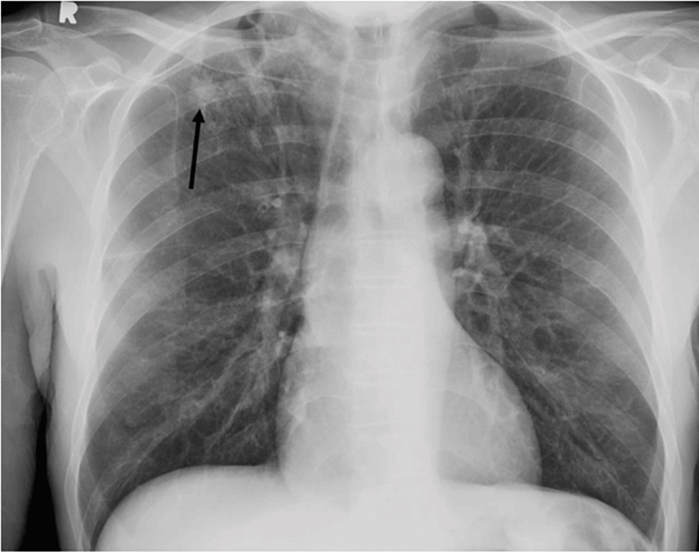 Chest X-ray showing right upper lobe nodule after bronchoscopy