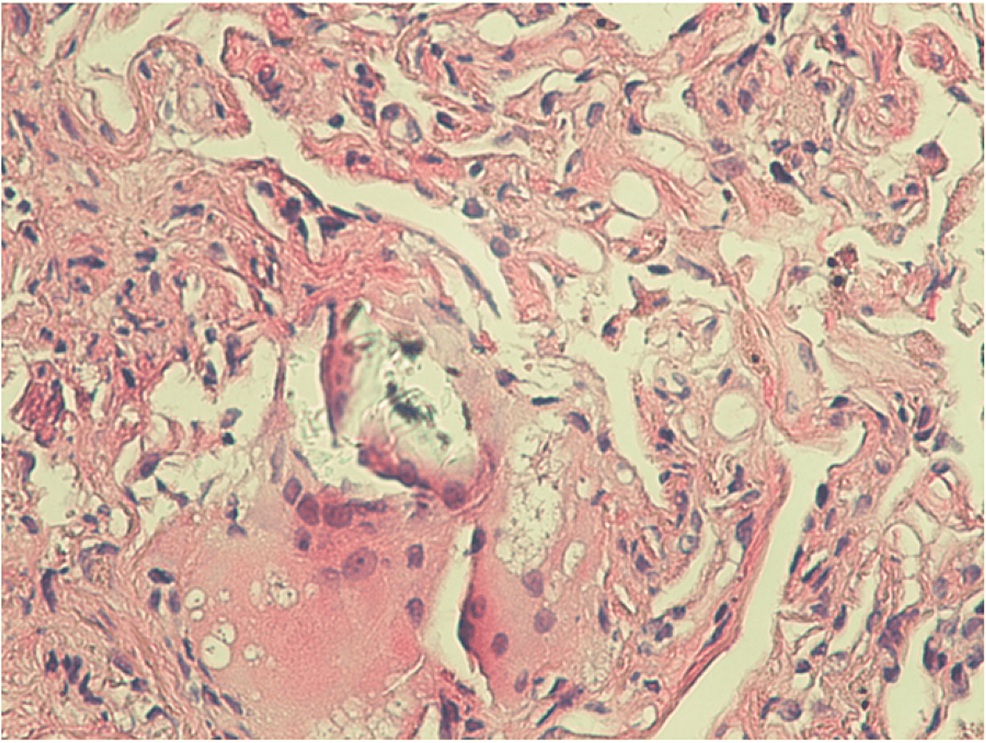 Pathology slide showing bronchial mucosa with subepithelial chronic inflammation, fibroelastosis, and ill-formed granuloma with multinucleated giant cells