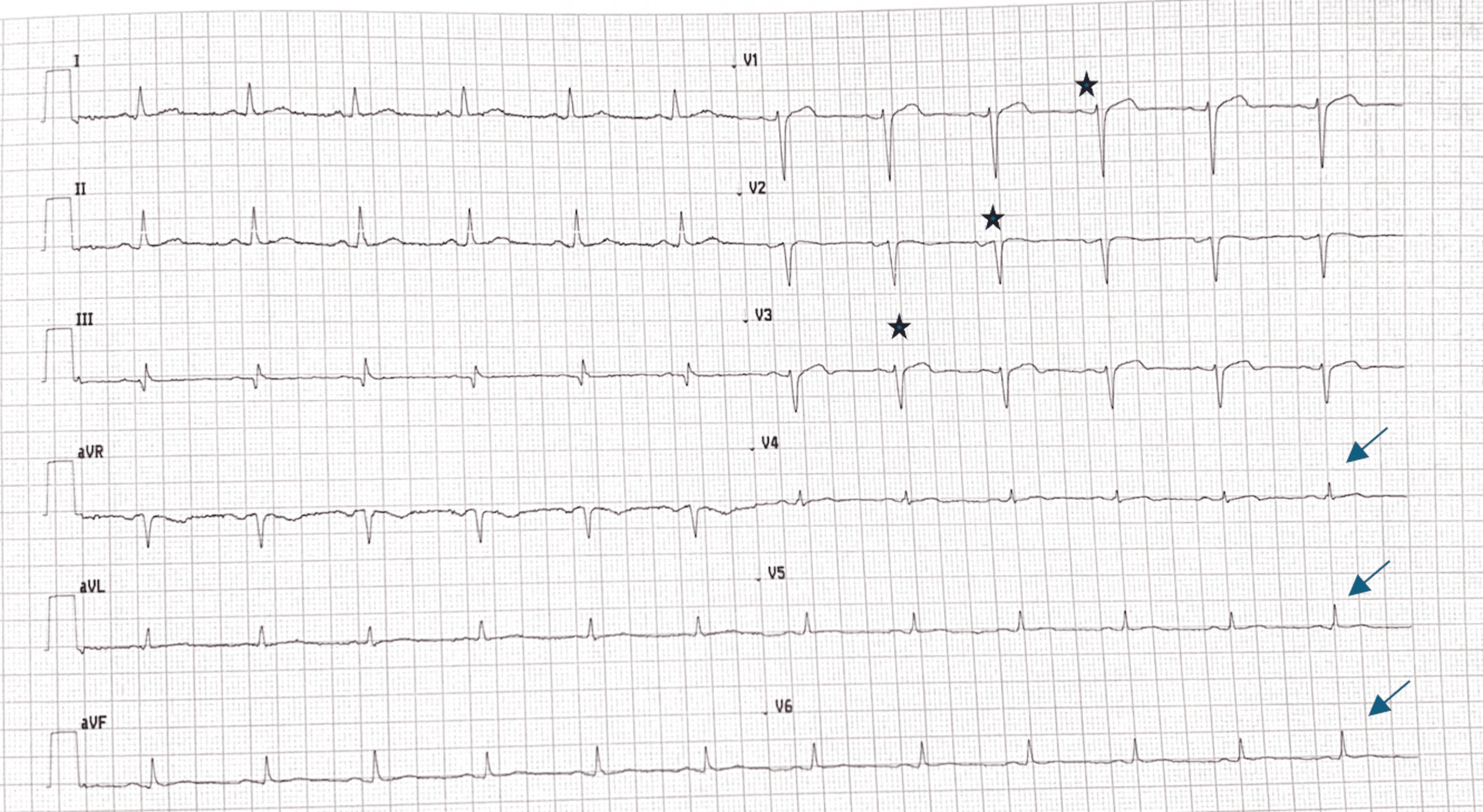 EKG showing prior anterior infarction pattern
