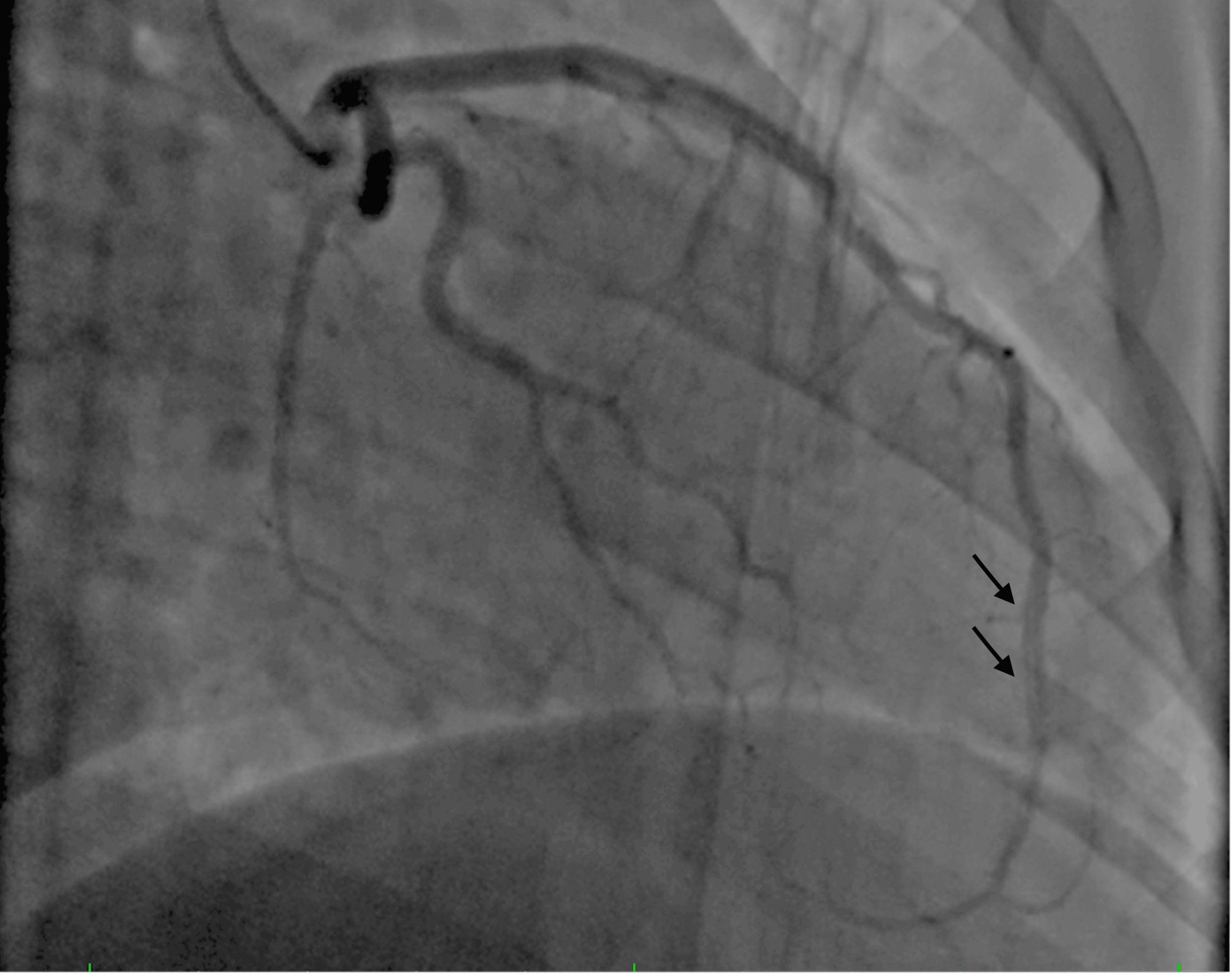 Coronary angiography showing multiple parallel channels in LAD