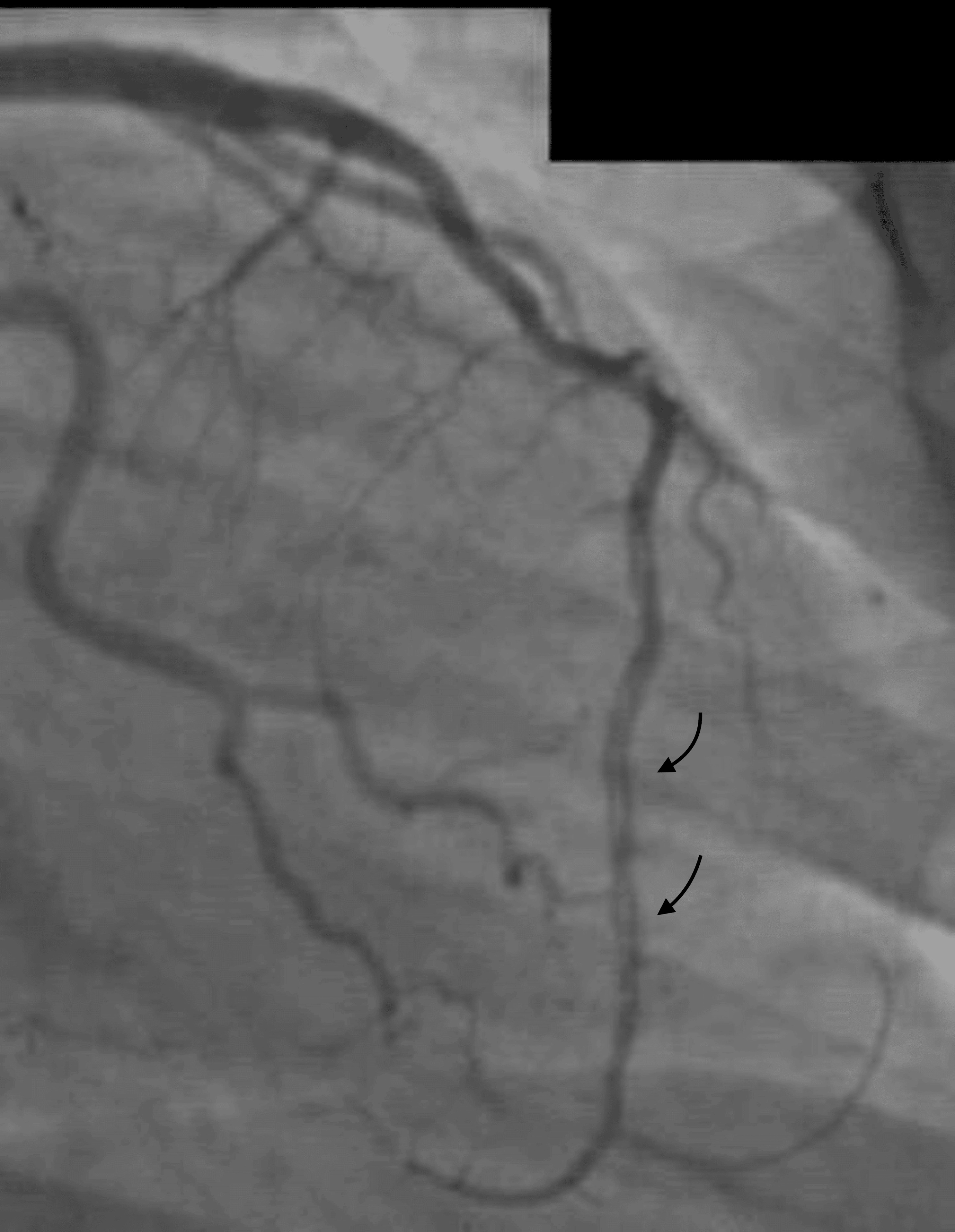 Follow-up angiography showing persistent dissection