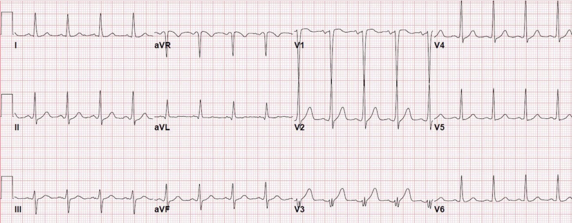 EKG sinus tachycardia