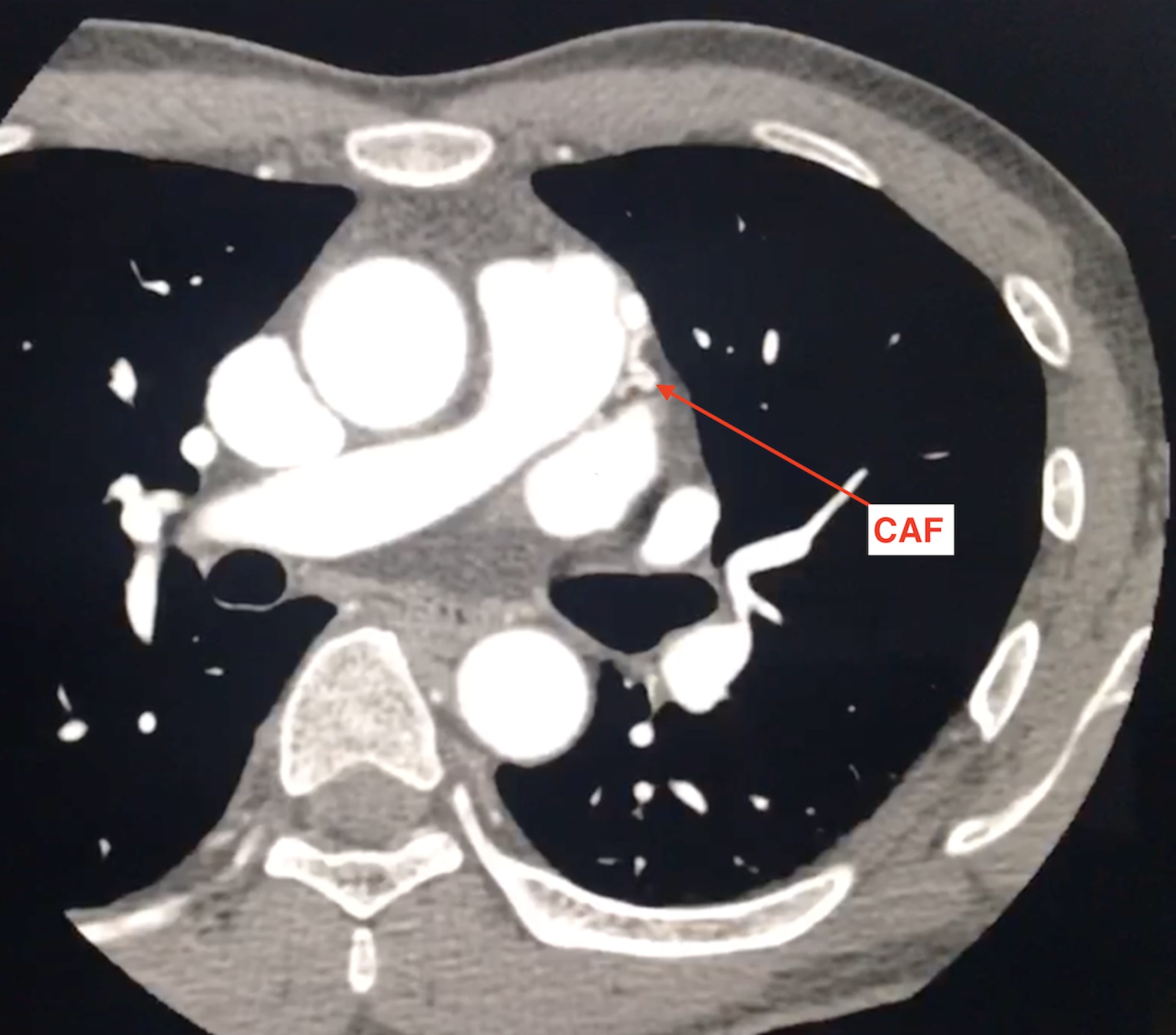 CT angiography coronary fistula tortuous vessels