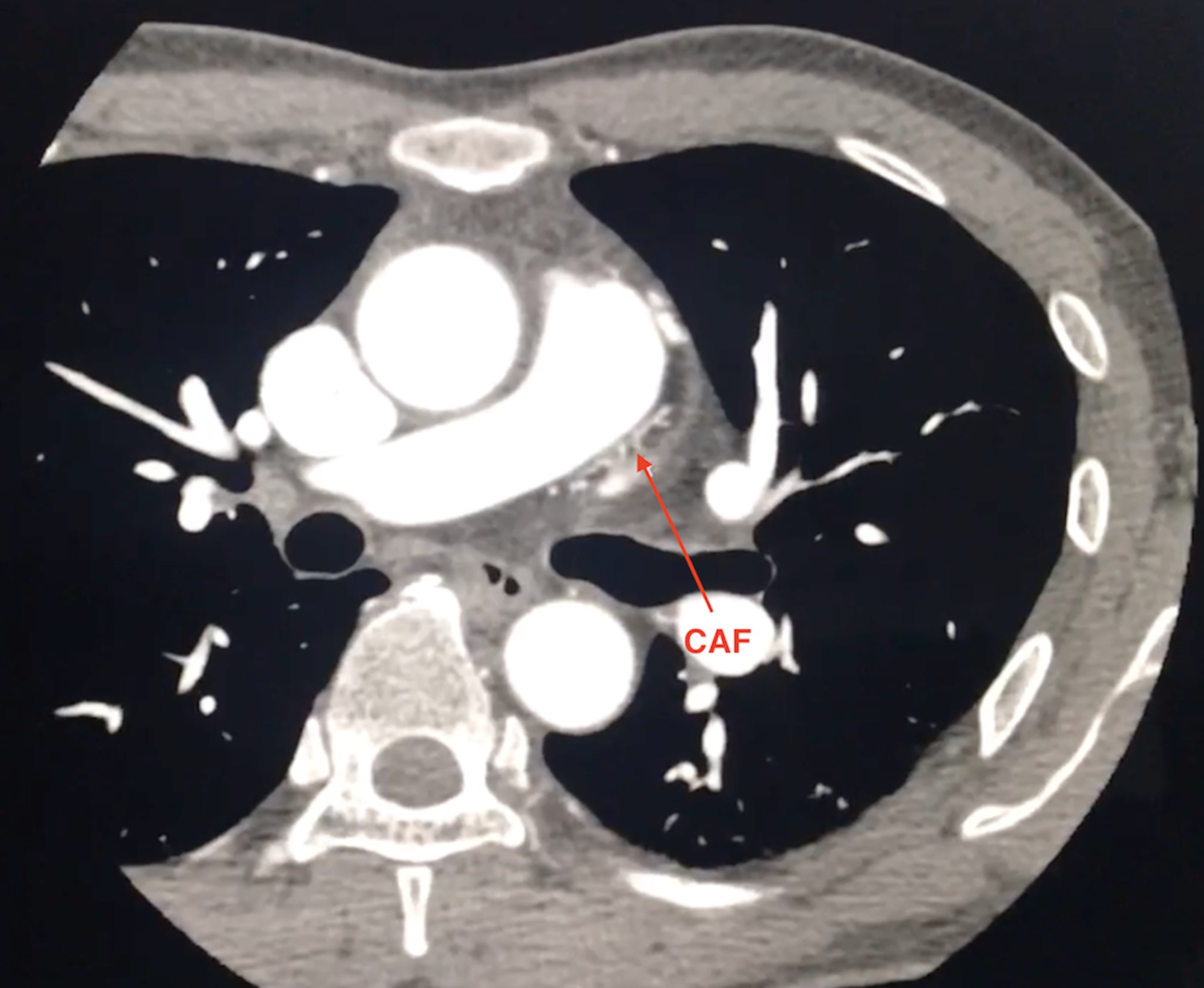 CT angiography network of vessels along PA trunk