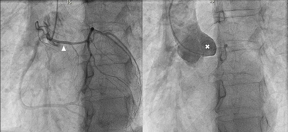 Coronary angiography single coronary artery