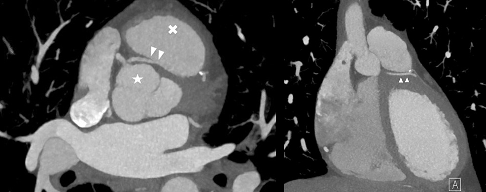 CCTA single coronary artery course