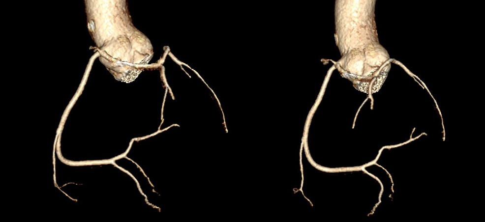 CCTA 3D reconstruction
